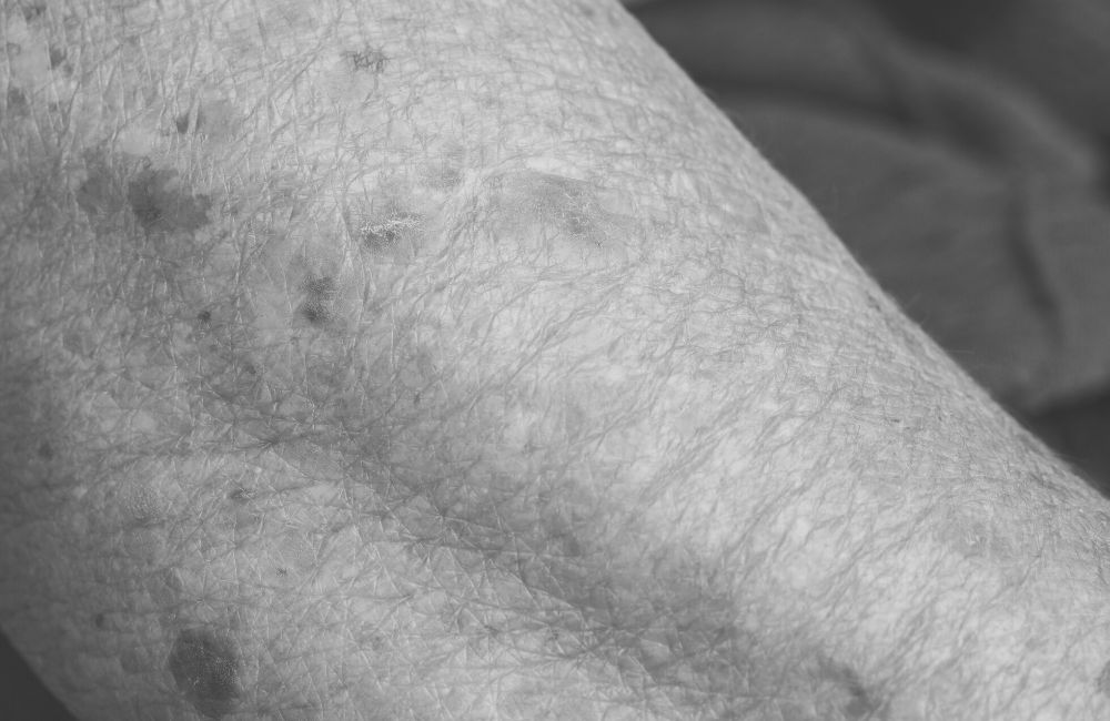 Crepey Skin on Arms Treatment in Colorado Springs, Colorado