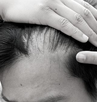 Hair Loss Treatments in Colorado Springs, Colorado.