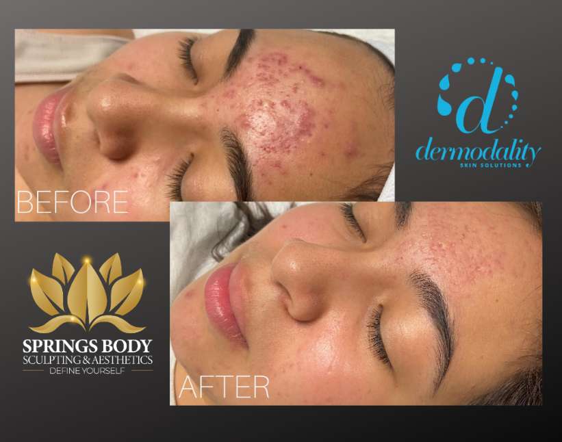 Colorado Springs Premier Med Spa Springs Body Sculpting