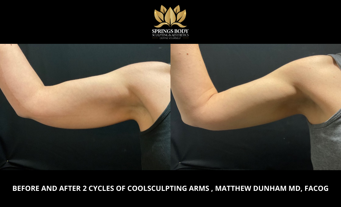 Before and after 2 cycles of Coolsculpting Arms