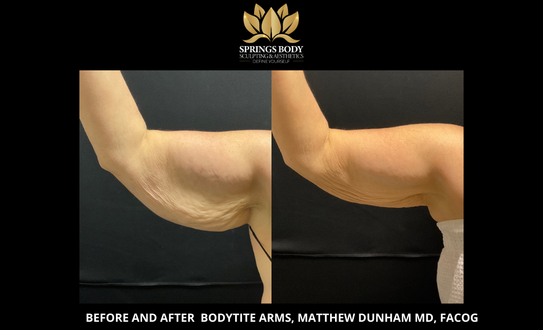 Before and after Bodytite Arms