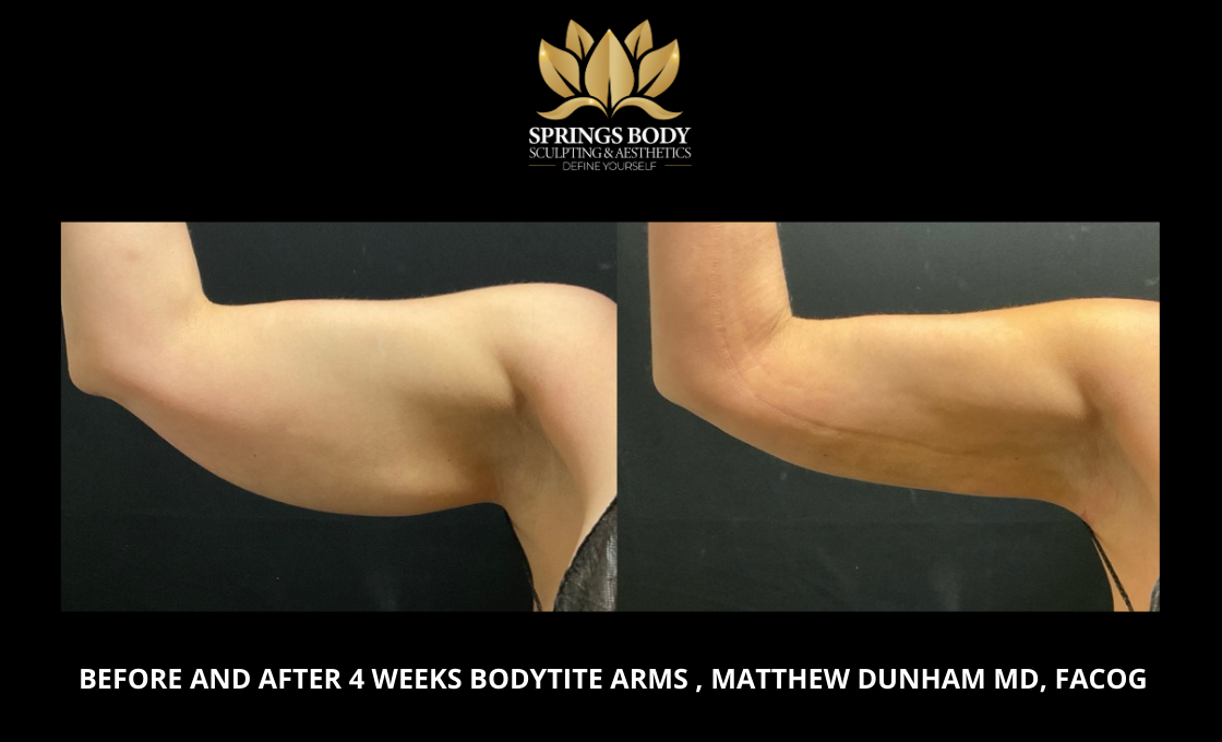 Before and after 4 weeks of Bodytite Arms