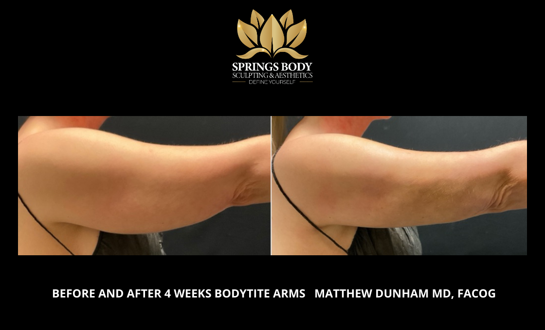 Before and after 4 weeks of Bodytite Arms