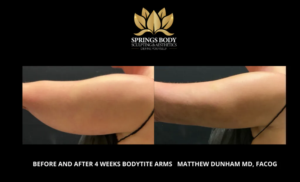 Before and after 4 weeks of Bodytite Arms