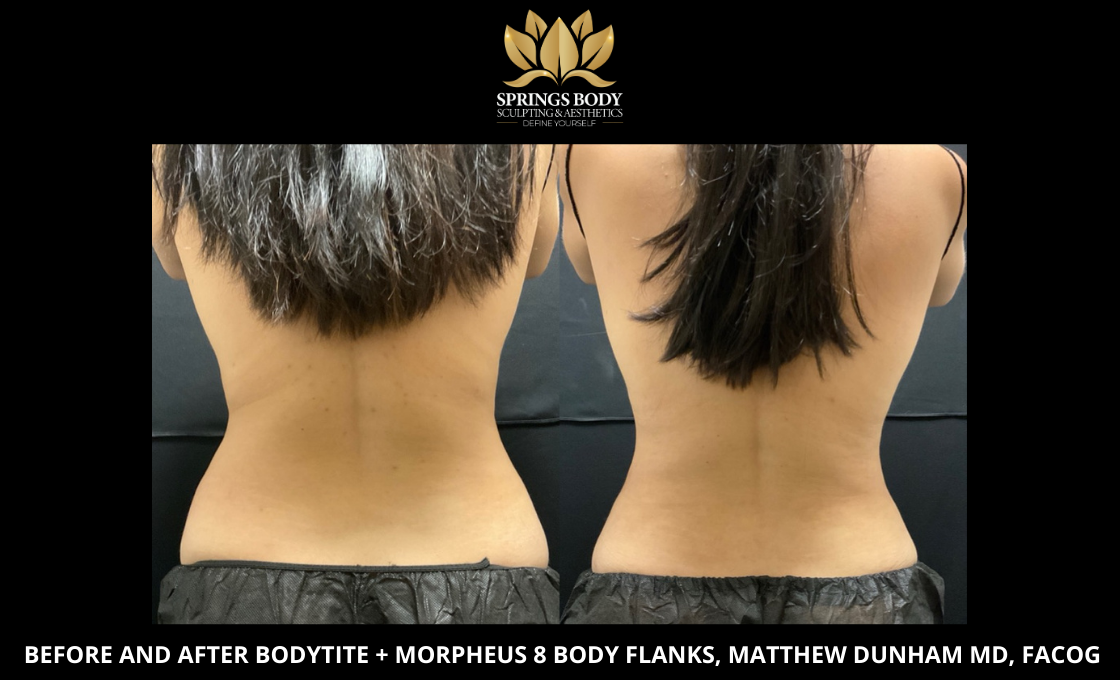 Before and after bodytitie and Morpheus8 Body and Flanks