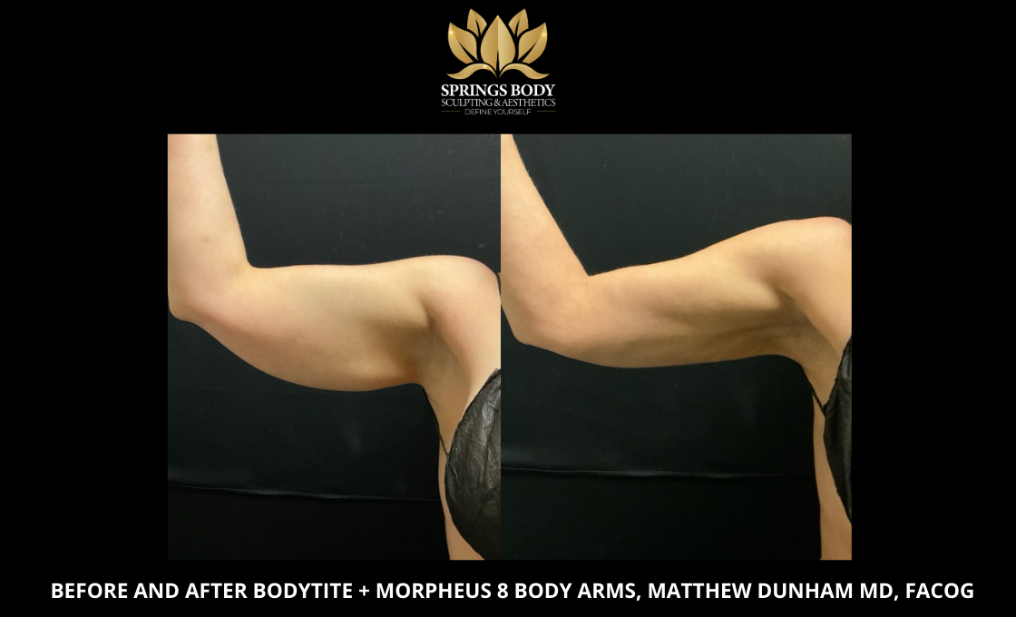 Before and after Bodytite and Morpheus8 Body and Arms