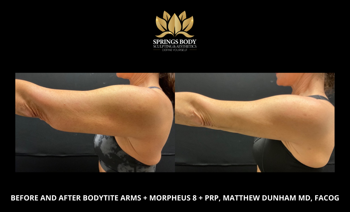 Before and after Bodytite Arms and Morpheus8 and PRP