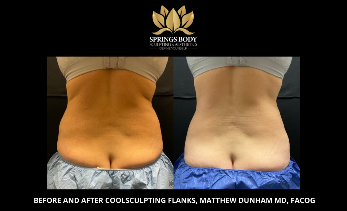 Before and after Coolsculpting Flanks