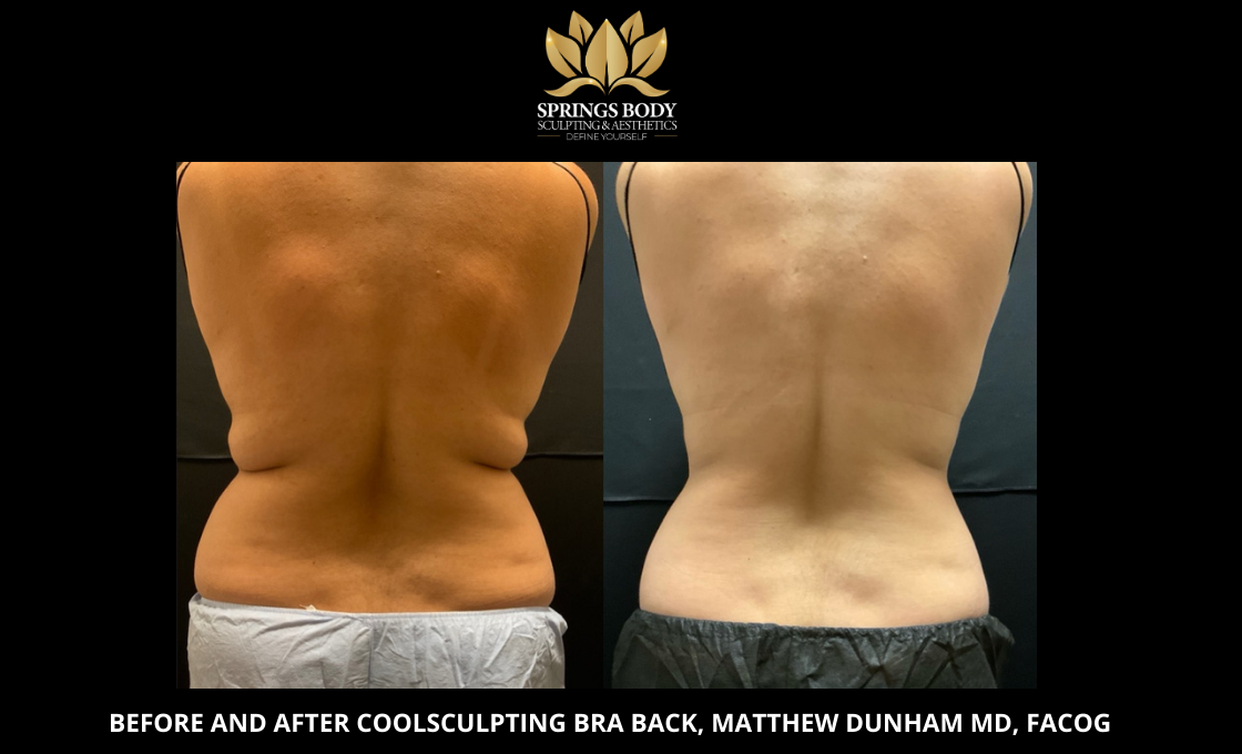 Before and after Coolsculpting Bra Back