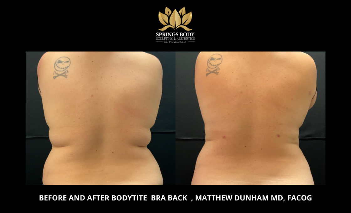 Before and after Bodytite Bra Back