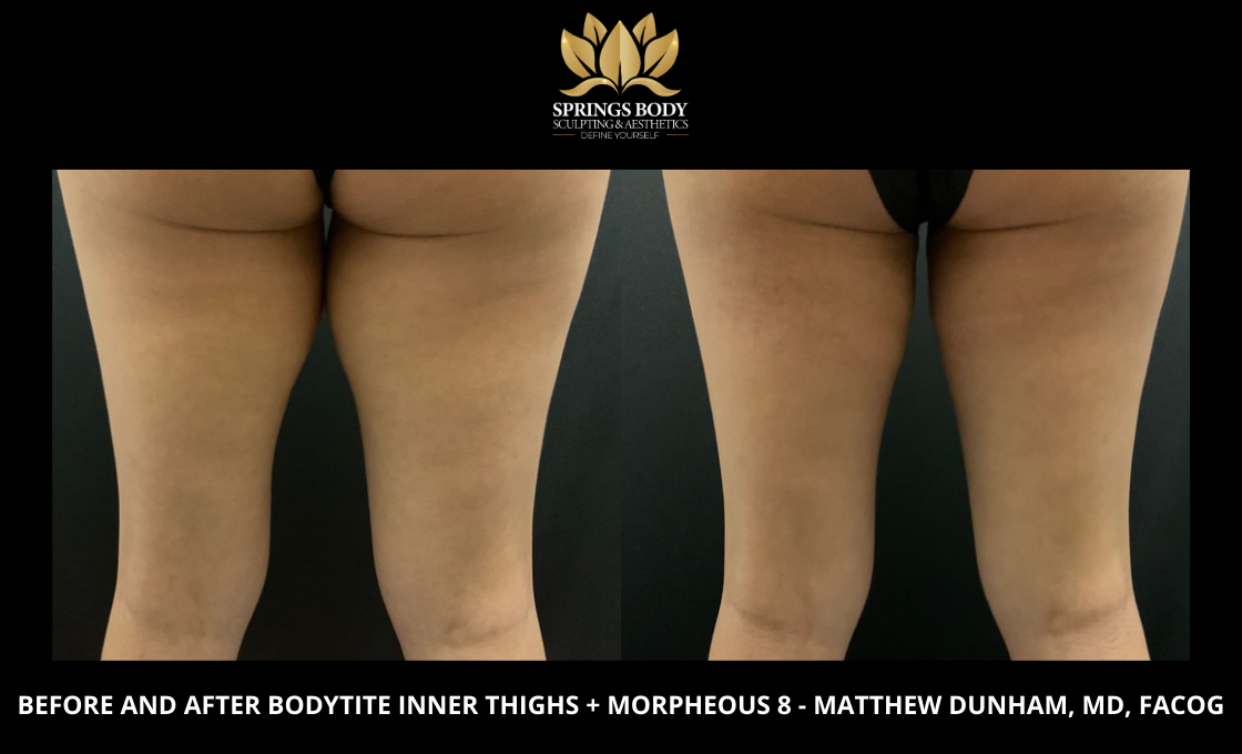 Before and after Bodytite Inner Thighs and Morpheus8