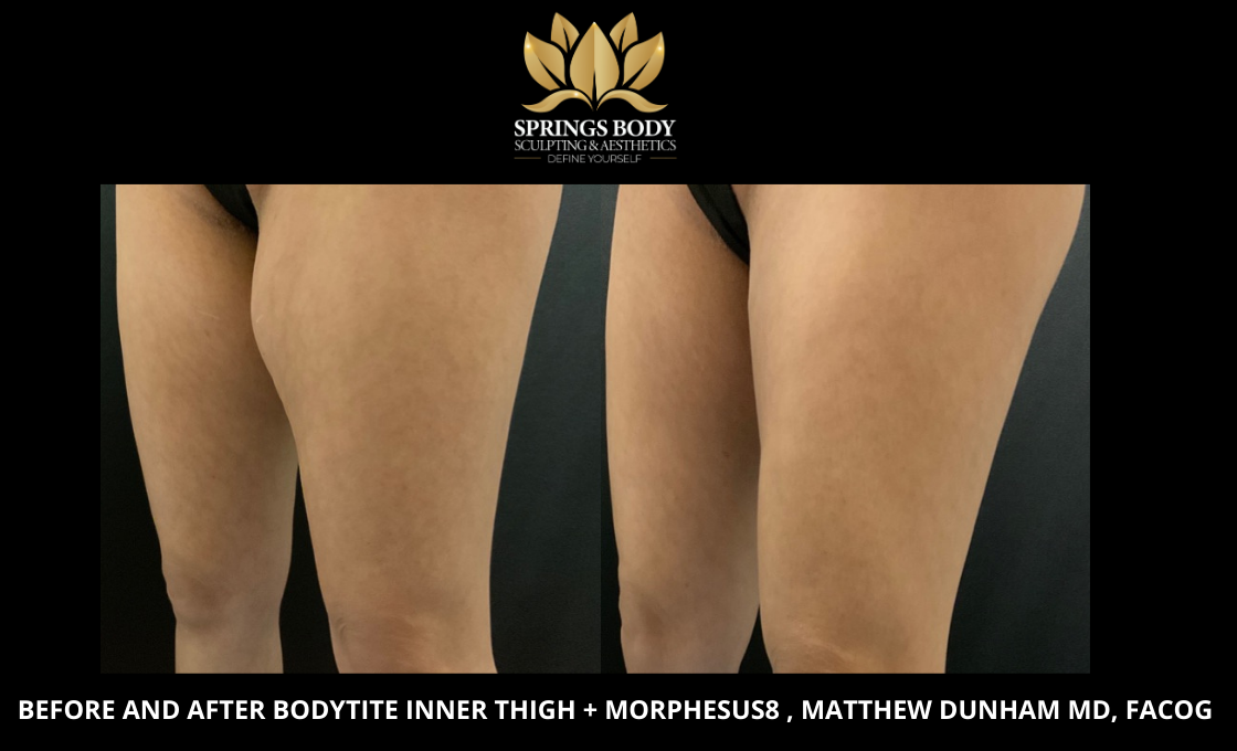 Before and after Bodytite Inner Thighs and Morpheus8