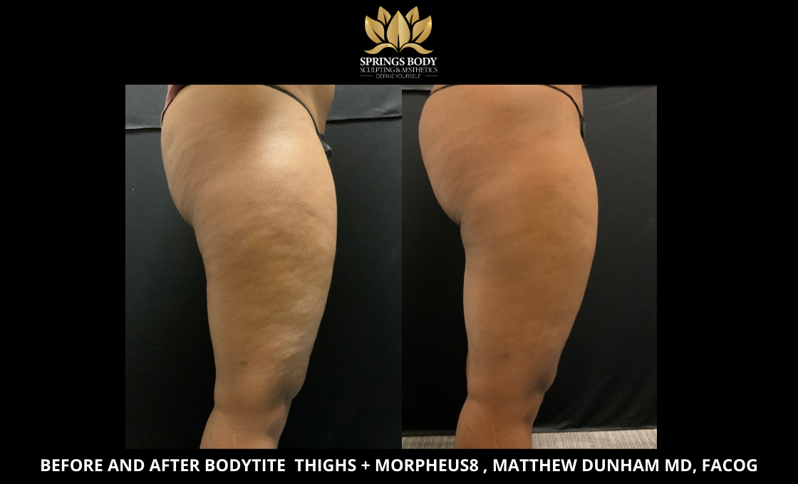 Before and after Bodytite Thighs and Morpheus8
