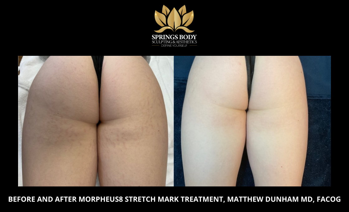 Before and after Morpheus8 Stretch Mark treatment