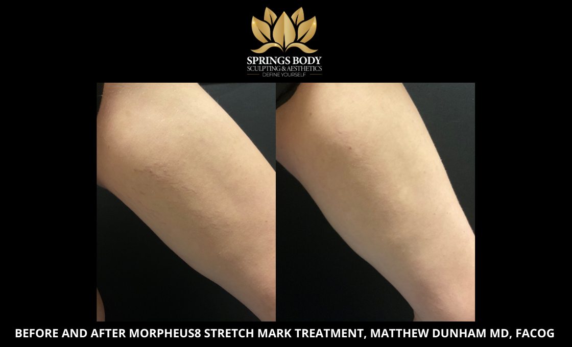 Before and after Morpheus8 Stretch Mark treatment