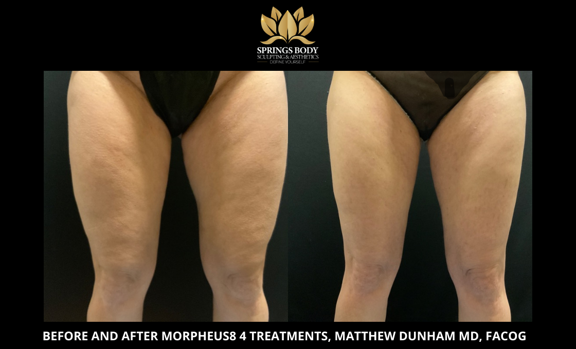 Before and after 4 treatments of Morpheus8