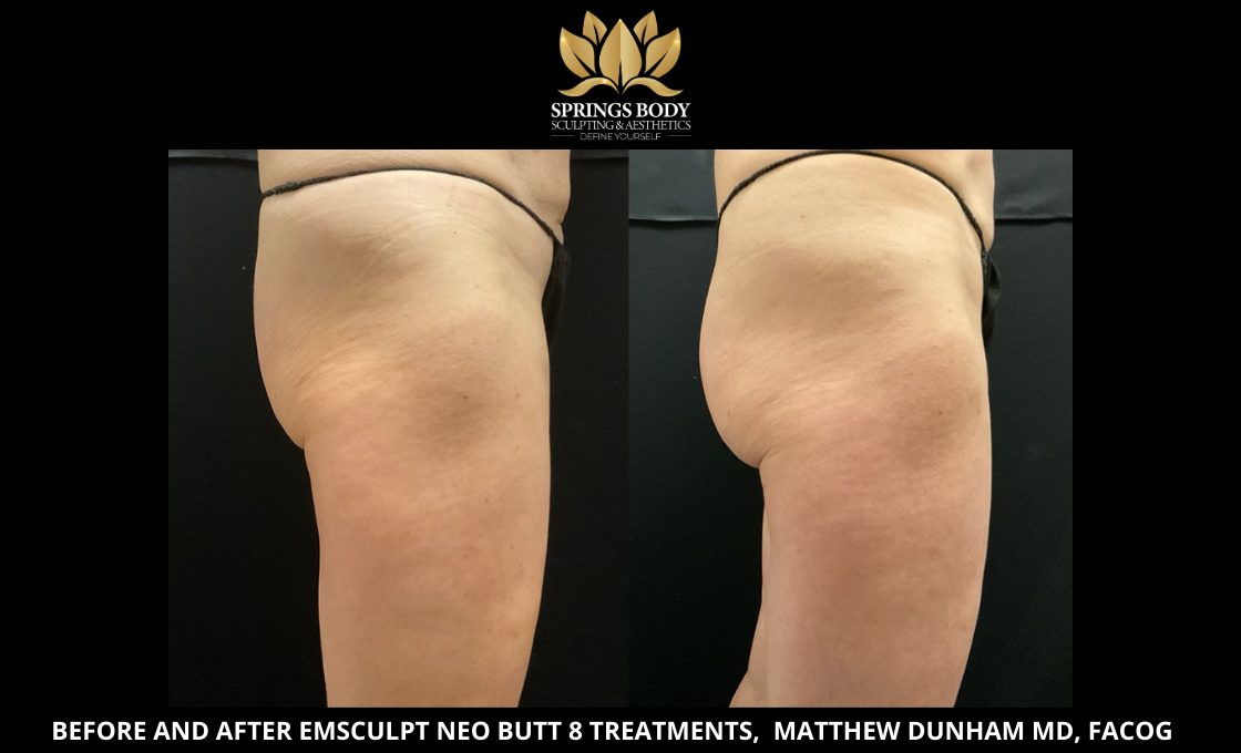 Before and after 8 treatments of Emsculpt Neo Butt