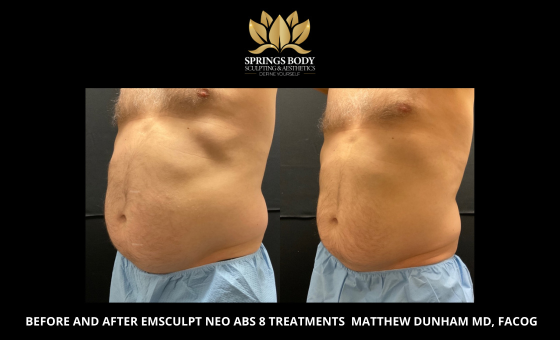 Before and after 8 treatments of Emsculpt Neo Abs