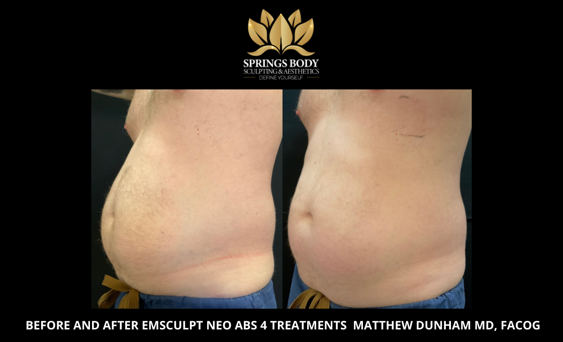 Before and after 4 treatments of Emsculpt Neo Abs