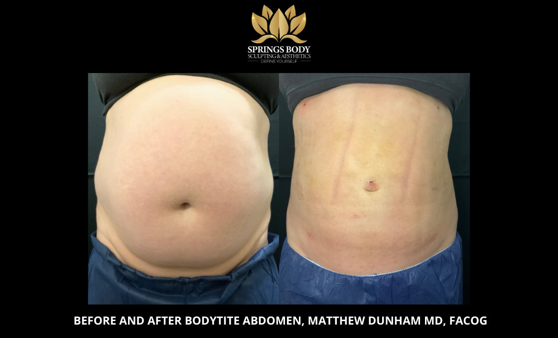 Before and after Bodytite Abdomen