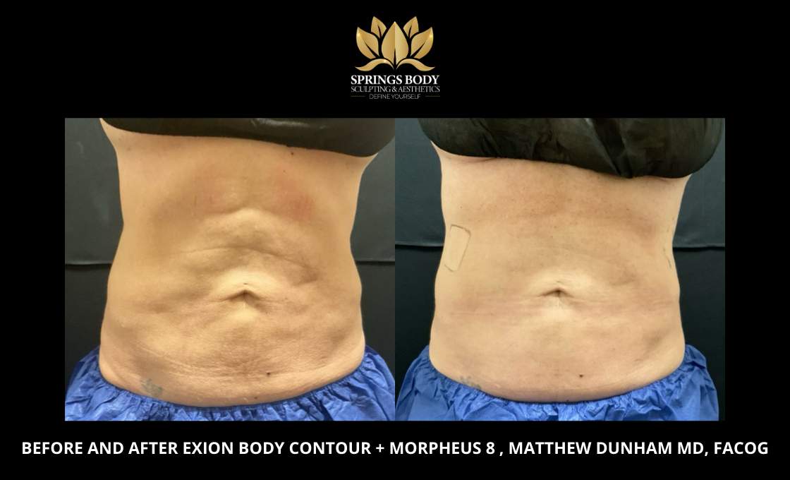 Before and after Exion Body Contour and Morpheus8