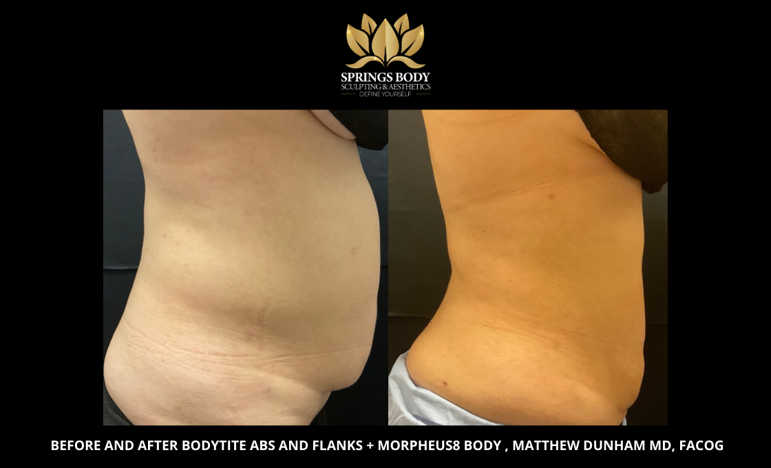 Before and after Bodytite Abs and Flanks and Morpheus8