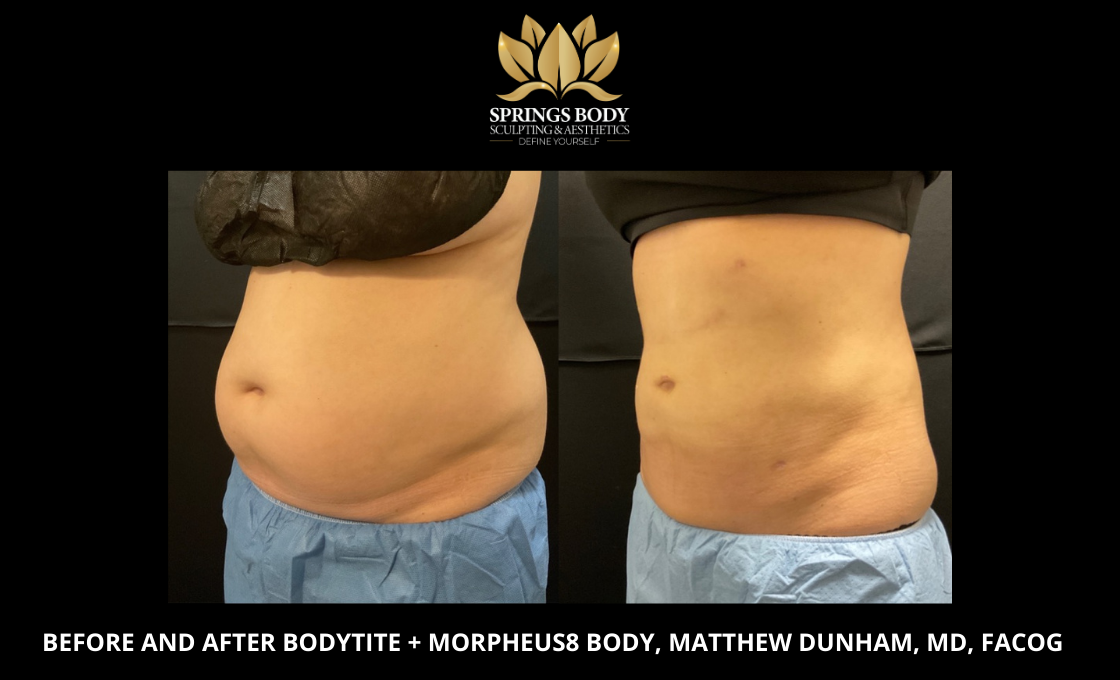Before and after Bodytite and Morpheus8