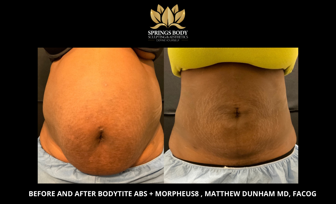 Before and after Bodytite abs and Morpheus8