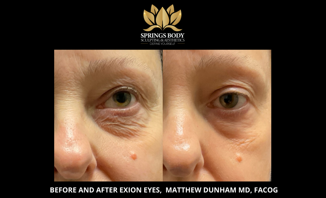 Before and after Exion Eyes