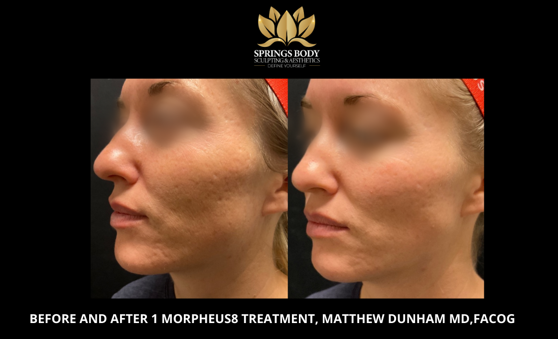 Before and after 1 Morpheus8 treatment