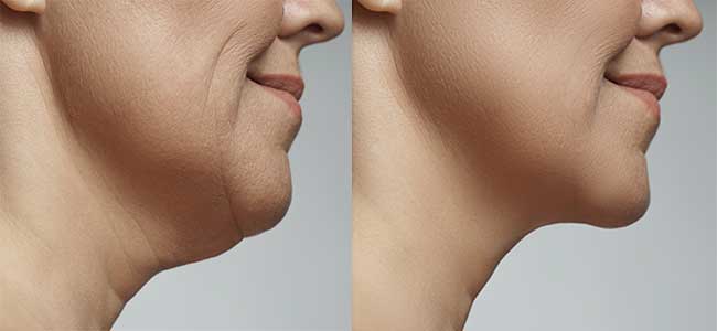 before-after-chin-1
