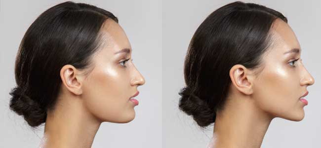 before-after-chin-2