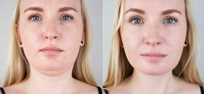 before-after-chin-3