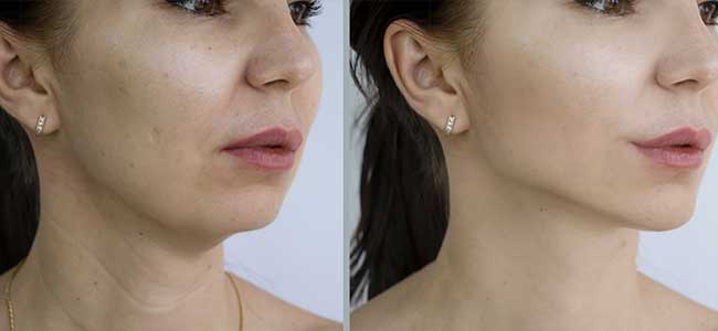 before-after-clearrf-1