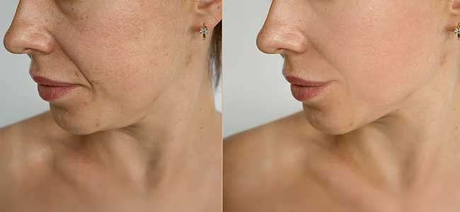 before-after-forma-1