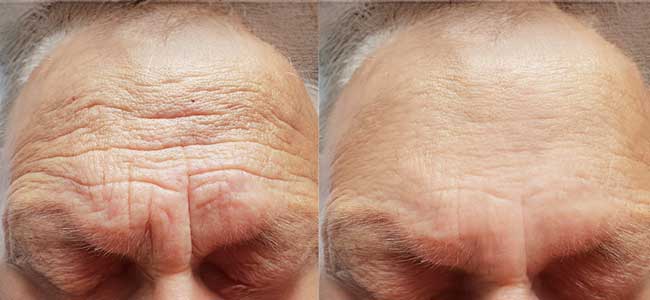 before-after-forma-3