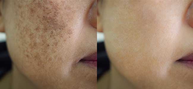 before-after-lumecca-ipl-1