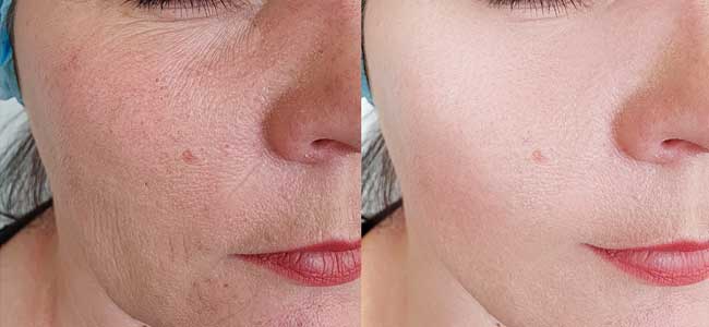 before-after-lumecca-ipl-2
