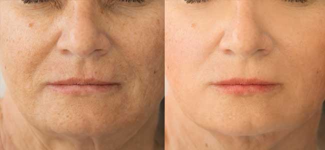 before-after-lumecca-ipl-3