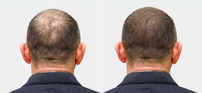 before-after-ted-2
