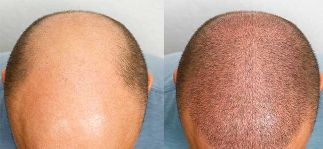before-after-ted-3