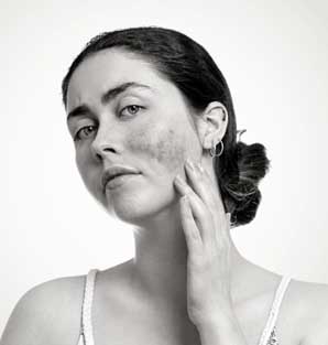 Rosacea