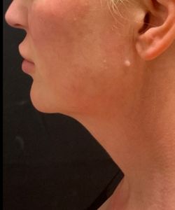 Belly contouring results — Lift & Tighten, Springs Body Sculpting