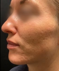 Belly contouring results — Smooth & Correct, Springs Body Sculpting