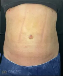 BodyTite Abs — after photo, Springs Body Sculpting patient