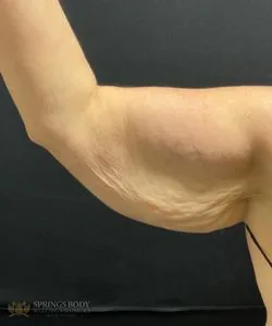 BodyTite Arms Batwings — before photo, Springs Body Sculpting patient