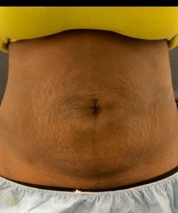 BodyTite And Morpheus8 Abs — after photo, Springs Body Sculpting patient
