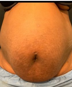 BodyTite And Morpheus8 Abs — before photo, Springs Body Sculpting patient