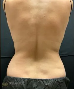 CoolSculpting Back — after photo, Springs Body Sculpting patient