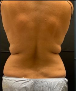 CoolSculpting Back — before photo, Springs Body Sculpting patient